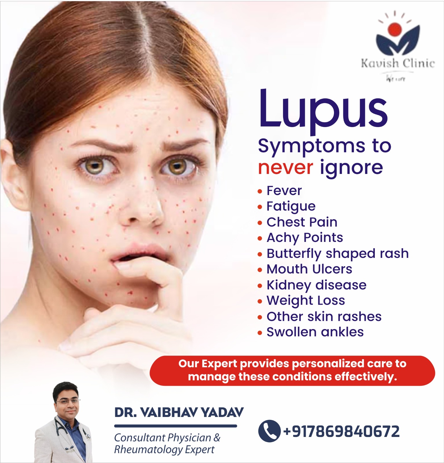 Best Doctor for Lupus Treatment in Indore