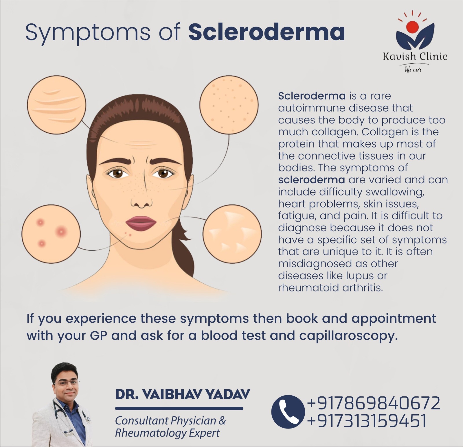 Best Doctor for Scleroderma Treatment in Indore
