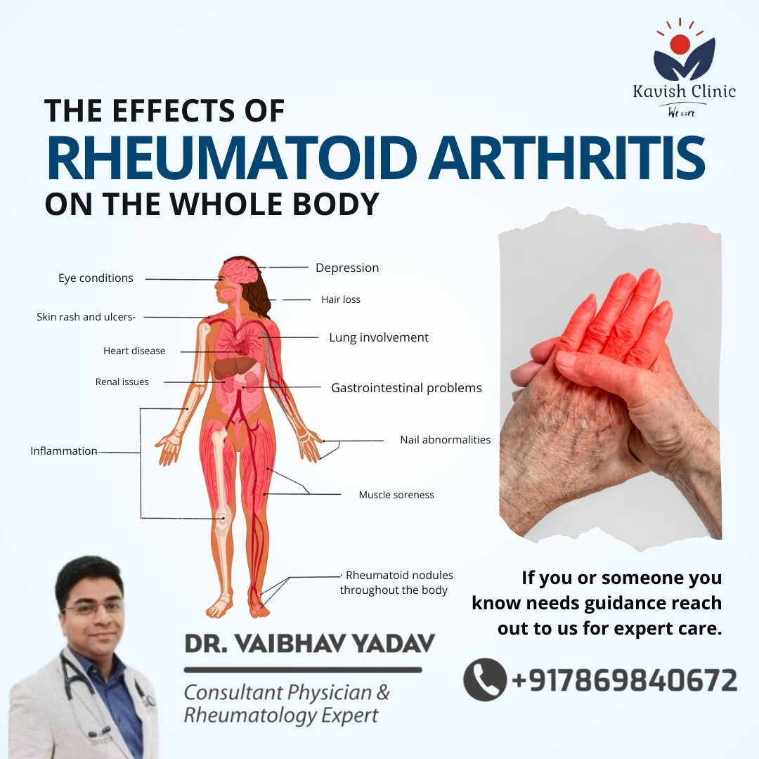 Best Rheumatologist In Indore