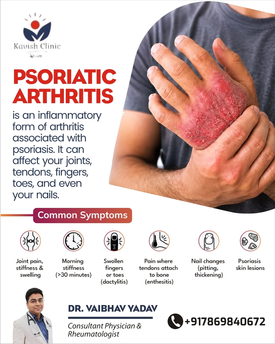 Psoriatic Arthritis Treatment in Indore: Symptoms, Diagnosis, and Joint Care