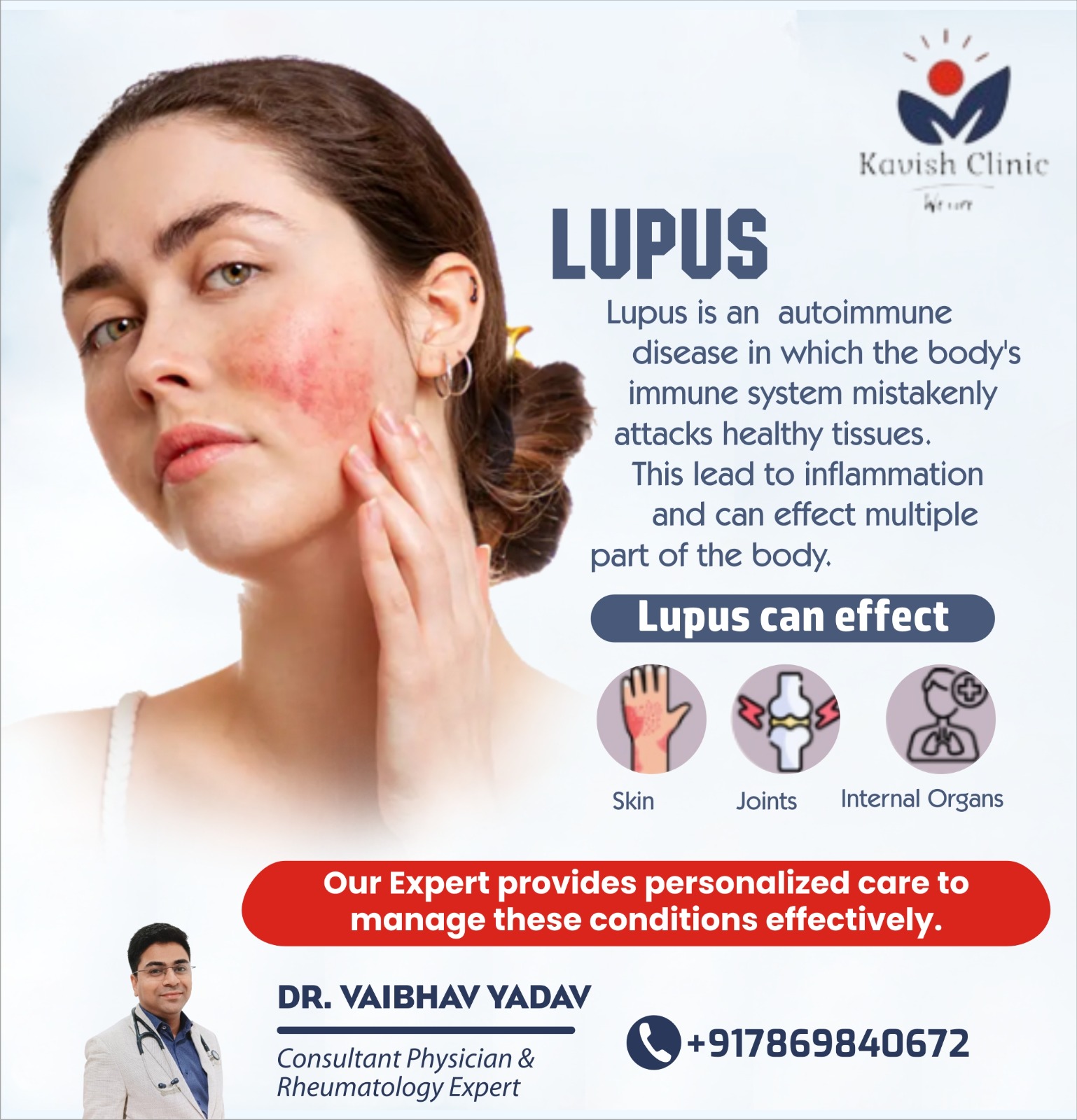 Best Lupus Treatment in Indore