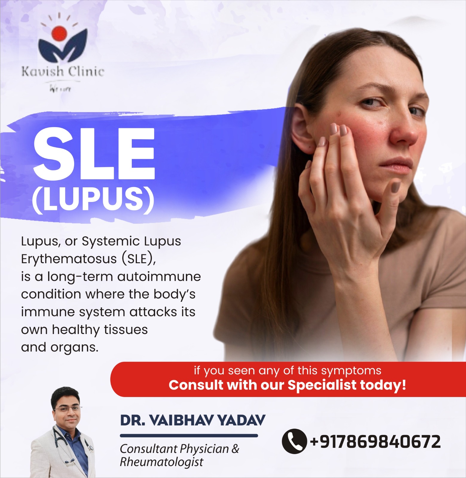 Best SLE Treatment in Indore 