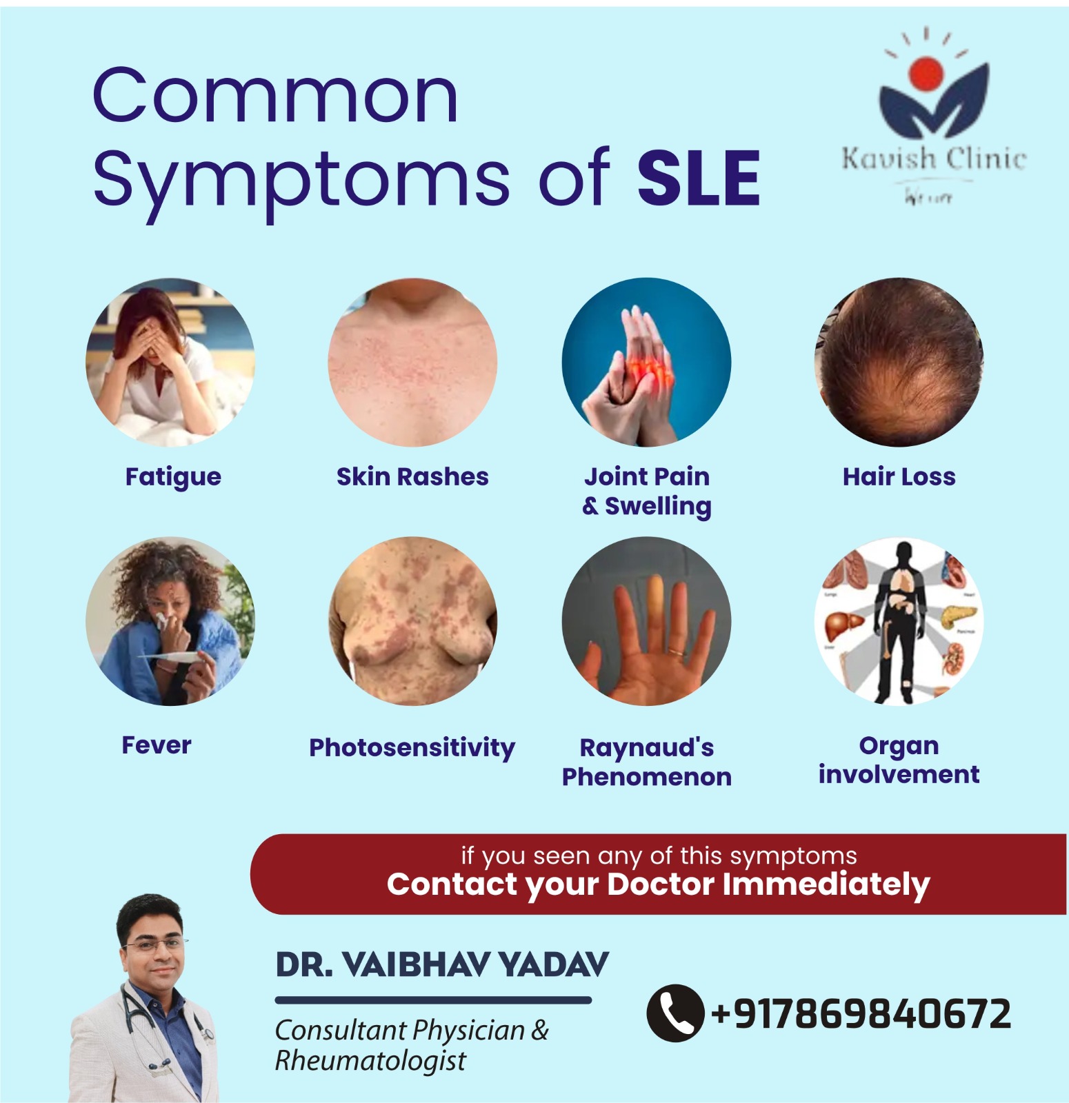 Best Doctor for SLE Treatment in Indore