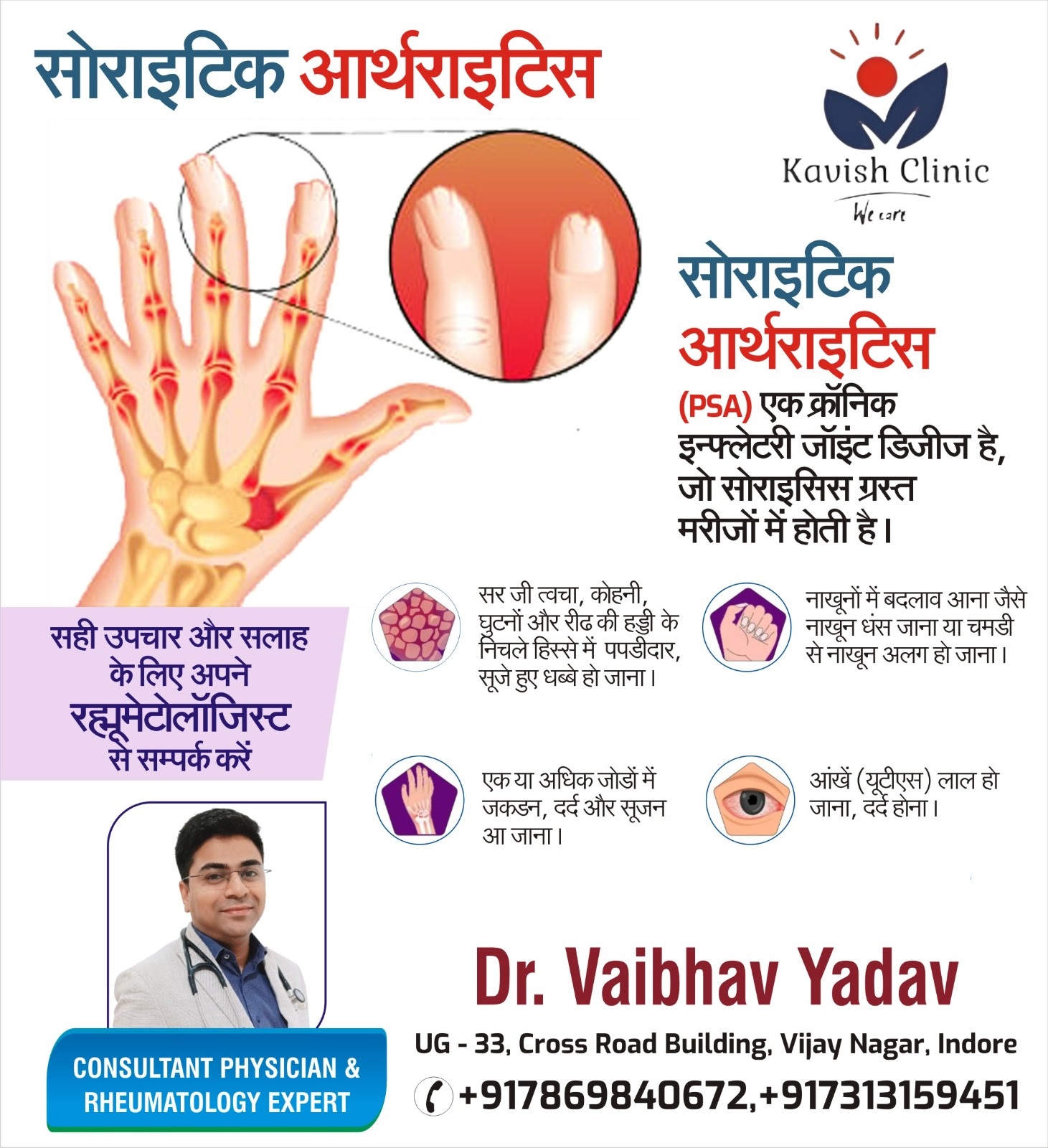 psoriatic arthritis treatment in Indore